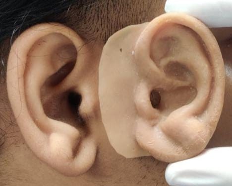 केजीएमयू डाॅक्टर का अद्धभुत काम, 3 डी प्रिंटिंग से मरीज़ का बना डाला कृत्रिम कान