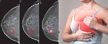 ब्रेस्ट कैंसर में अब स्तन खोने का भय नहीं, सर्जरी से हो सकता है पुनर्निमाण